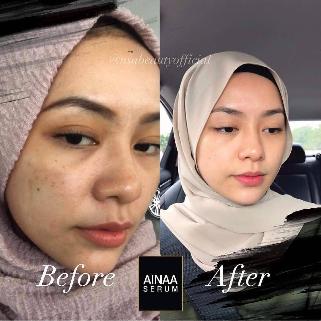 Cara Menghilangkan Jeragat: Rahsia Kulit Cantik Tanpa Jeragat